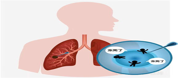 消融刀5